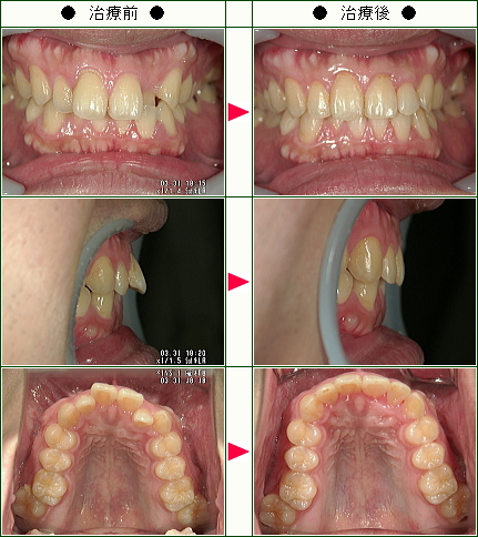出っ歯矯正症例(Ｔ・Ｍ様　３３歳　男性)