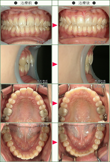 出っ歯矯正症例(Ｔ.Ｍ様　４３歳　女性)