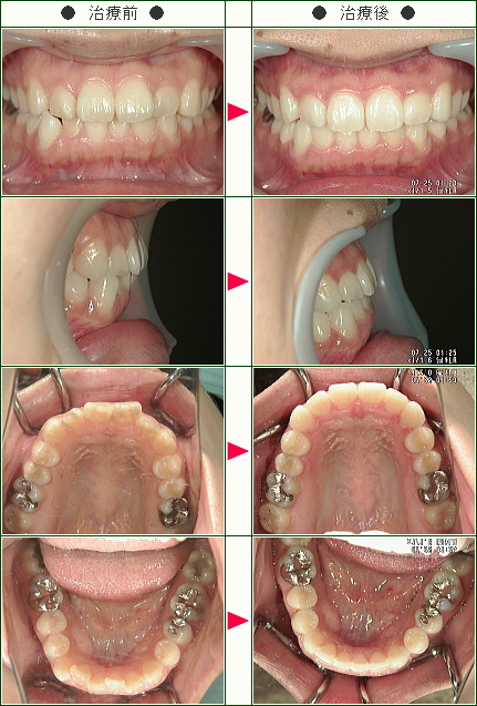 歯のデコボコ矯正症例(Ｔ.Ｎ様　２７歳　女性)