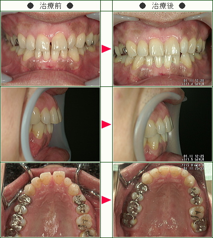 前歯のすきっ歯矯正症例(Ｔ.Ｎ様　３５歳　男性)