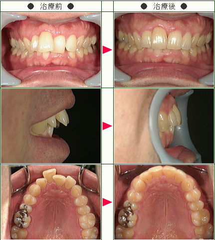 歯のデコボコ症例(Ｔ.Ｎ様　４６歳　男性)