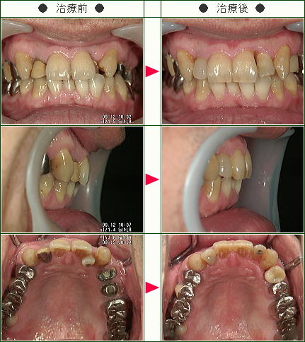 歯のデコボコ矯正症例(Ｔ・Ｎ様　４６歳　男性)