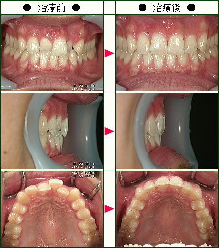 歯のデコボコ矯正症例(Ｔ・Ｏ様　１８歳　男性)