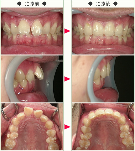 出っ歯矯正症例(戸見山様　２４歳　男性)