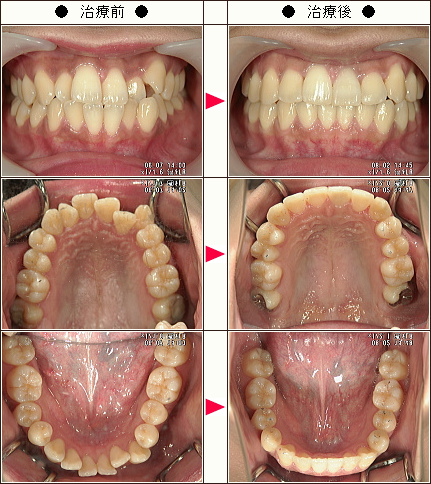 歯のデコボコ矯正症例［とも様　２６歳　女性］