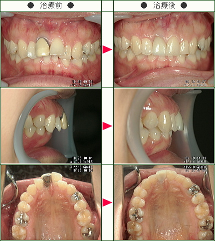 出っ歯矯正症例(Ｔ．Ｓ様　２９歳　女性)