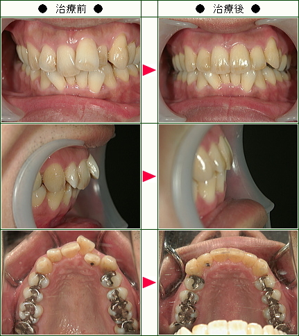 歯のデコボコ矯正症例(Ｔ.Ｓ様　３６歳　男性)