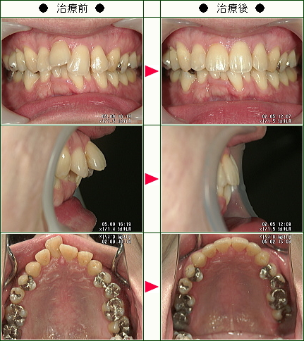歯のデコボコ矯正症例(Ｔ・Ｓ様　３６歳　男性)