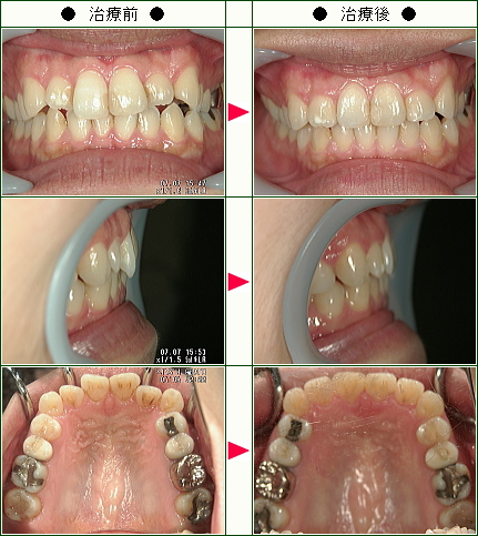 歯のデコボコ矯正症例(津田様　２９歳　女性)