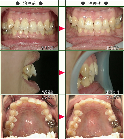 歯のデコボコ症例(ＴＳＵＭＵＴＳＵＢＵ様　４３歳　女性)