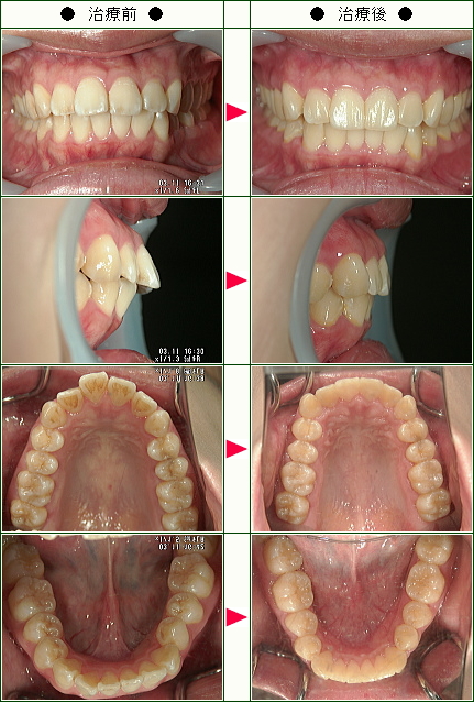 歯のデコボコ矯正症例(Ｔ.Ｔ様　２３歳　女性)