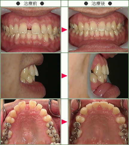 前歯のすきっ歯矯正症例(Ｔ．Ｔ様　３５歳　男性)