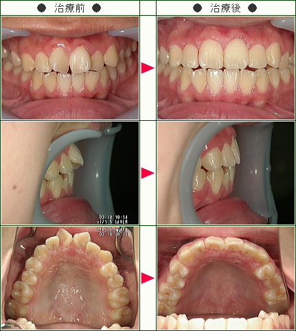 歯のデコボコ症例(Ｔ.Ｙ様　１５歳　男性)