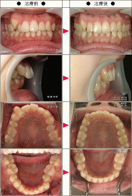 歯のデコボコ矯正症例［Ｔ・Ｙ様　２６歳　女性］