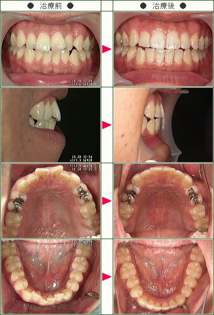 歯のデコボコ矯正症例(Ｔ・Ｙ様　３１歳　男性)