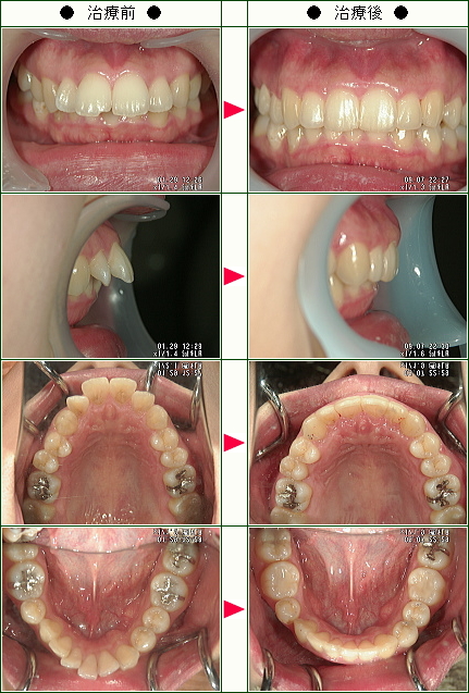 出っ歯矯正症例(Ｕ様　２８歳　女性)