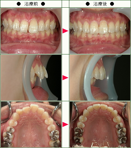 歯のデコボコ矯正症例(Ｕ様　４３歳　女性)
