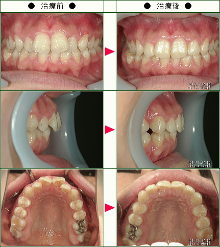 歯のデコボコ矯正症例(上野様　１８歳　女性)
