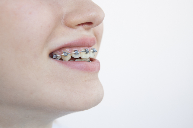 欠損歯がある場合の矯正治療の特徴