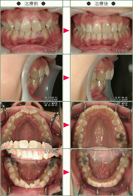 歯のデコボコ矯正症例(Ｕ史織様　３４歳　女性)