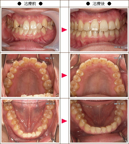 歯のデコボコ矯正症例［Ｕ由香様　２９歳　女性］