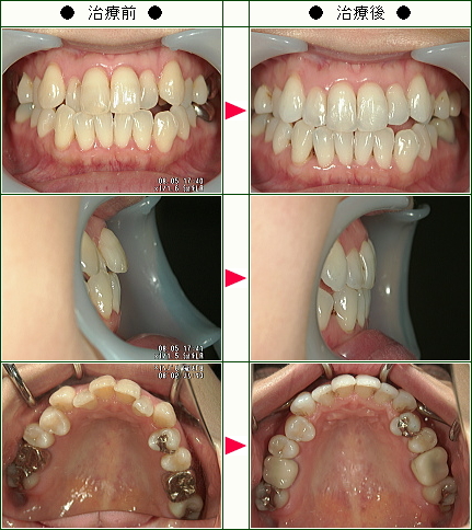 歯のデコボコ矯正症例(Ｗ様　３９歳　女性)