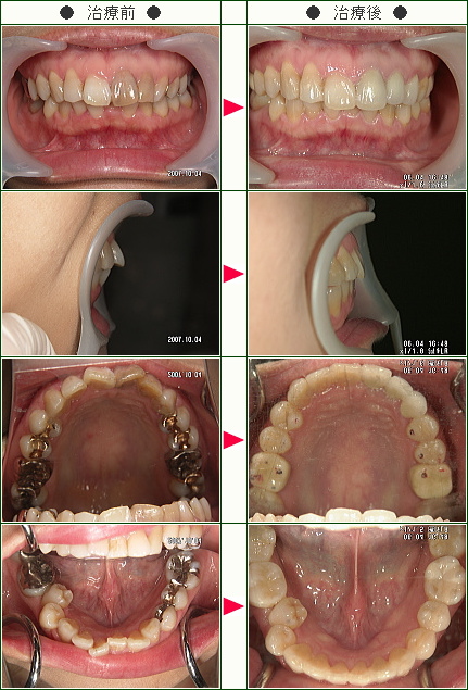 歯のデコボコ矯正症例(Ｗ様　女性)