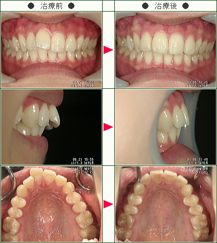 歯のデコボコ矯正症例(和田様　２３歳　女性)