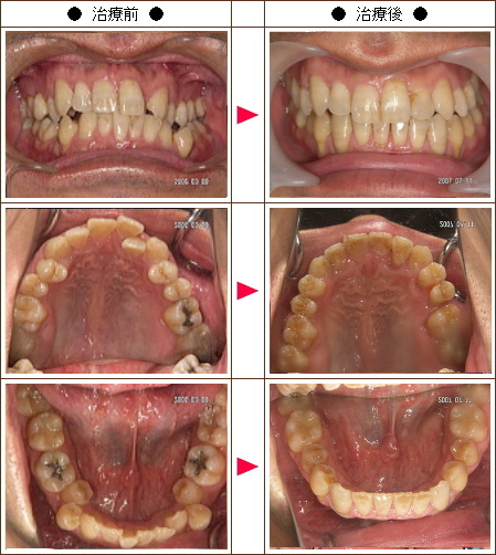 歯のデコボコ矯正症例［和田様　３９歳　男性］