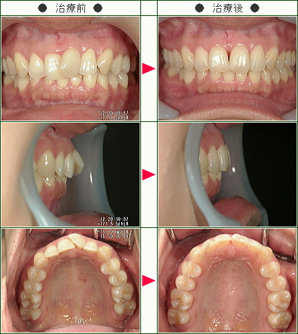 歯のデコボコ矯正症例(脇田様　３７歳　女性)