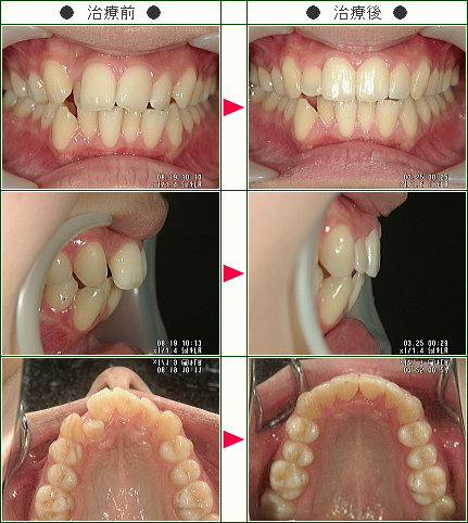 ☆歯のデコボコ矯正症例(渡辺様　２０歳　女性)