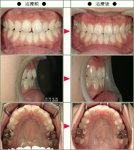 歯のデコボコ矯正症例(渡辺様　２１歳　女性)