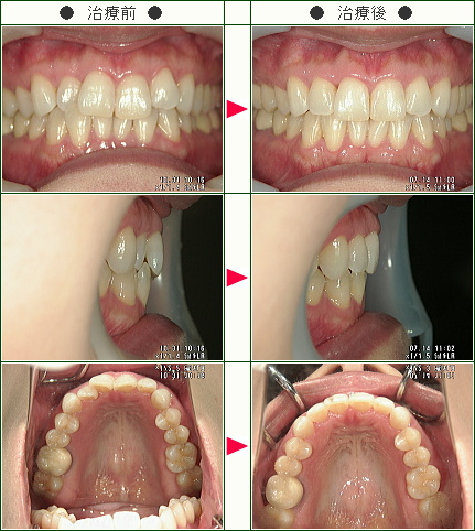 歯のデコボコ矯正症例(ワタナベ様　３６歳　女性)