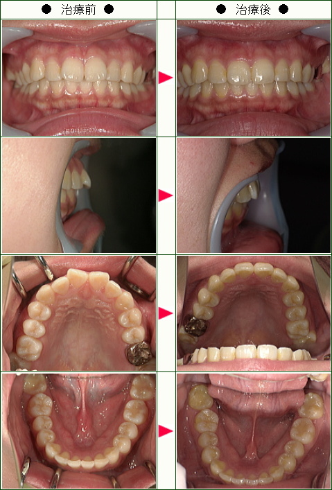 出っ歯矯正症例(わわわ様　２２歳　女性)