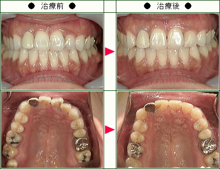 歯のデコボコ矯正症例(Ｗ.Ｎ様　３８歳　女性)