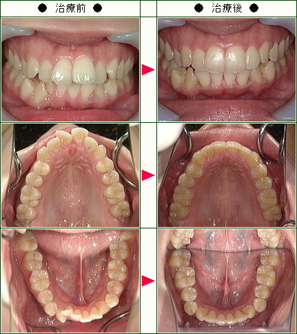 出っ歯矯正症例(Ｗ.Ｙ様　２１歳　女性)