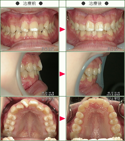歯のデコボコ矯正症例(Ｙ様　１８歳　女性)