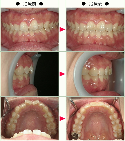 歯のデコボコ矯正症例(Ｙ様　２４歳　女性)