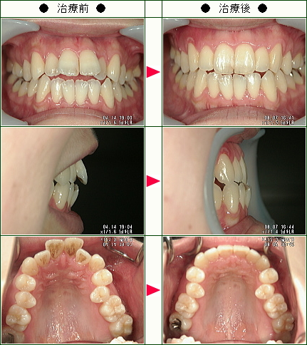 歯のデコボコ矯正症例(Ｙ様　２５歳　女性)