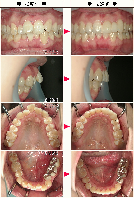 歯のデコボコ矯正症例［Ｙ様　２６歳　女性］