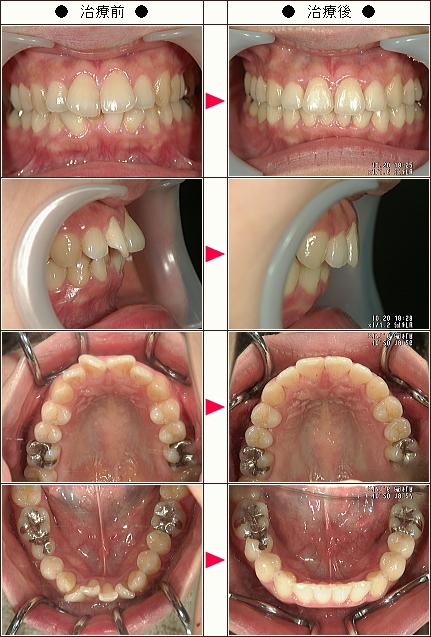 出っ歯矯正症例［Ｙ様　２９歳　女性］
