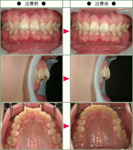 歯のデコボコ矯正症例(Ｙ様　３０歳　女性)
