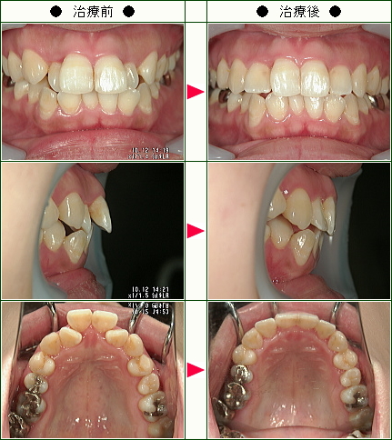 出っ歯矯正症例(Ｙ様　３０歳　女性)