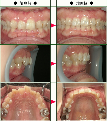 歯のデコボコ矯正症例(Ｙ様　３１歳　女性)