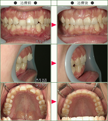 歯のデコボコ矯正症例(Ｙ様　３４歳　女性)