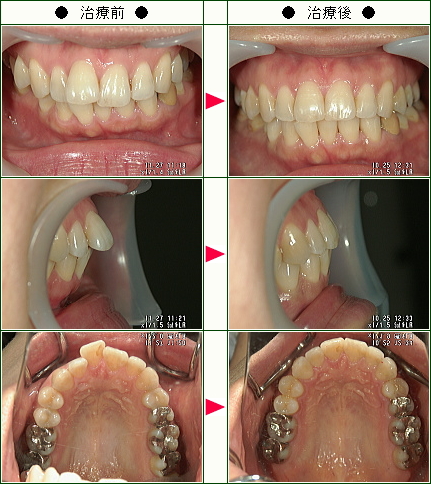 歯のデコボコ矯正症例(Ｙ様　３８歳　女性)