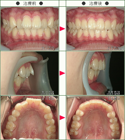 歯のデコボコ症例(Ｙ．Ａ様　１６歳　女性)