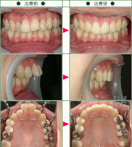 出っ歯矯正症例(Ｙ．Ａ様　２５歳　女性)
