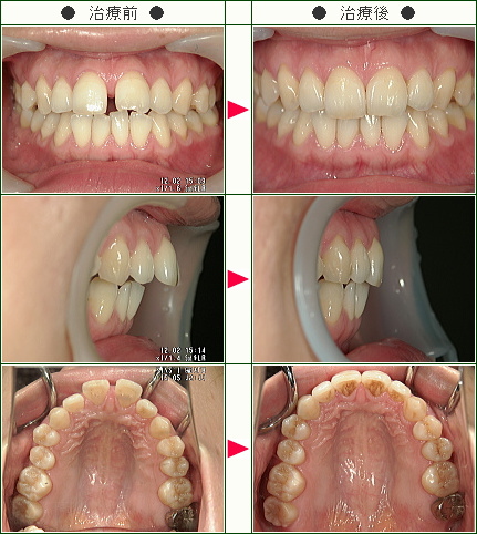 前歯のすきっ歯矯正症例(Ｙ・Ａ様　３０歳　女性)