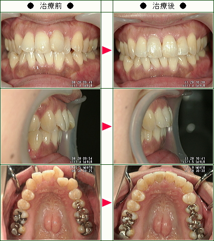 歯のデコボコ矯正症例(Ｙ・Ａ様　３７歳　女性)